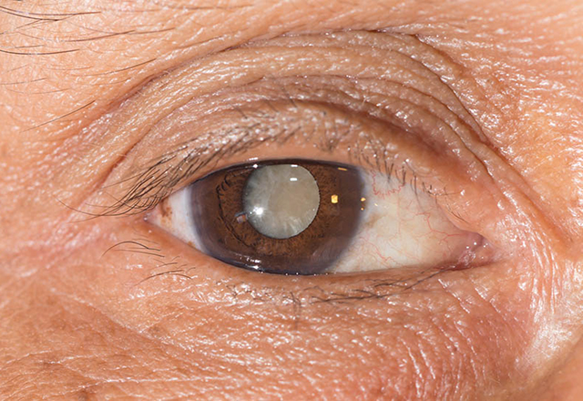 Secretaria de Saúde Diminui a Fila de espera por Cirurgia de Catarata